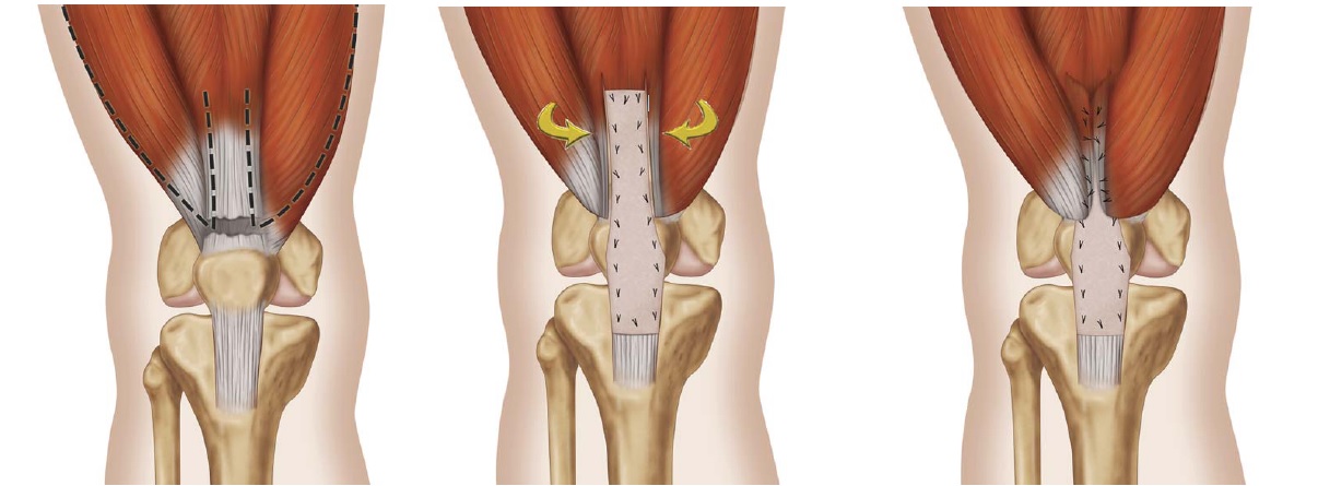 Rupturas del aparato extensor de la rodilla, incluidas las