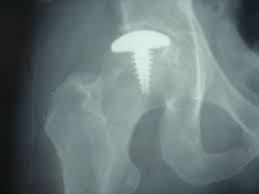HEMICAP HIP htttps://biotechpromed.com