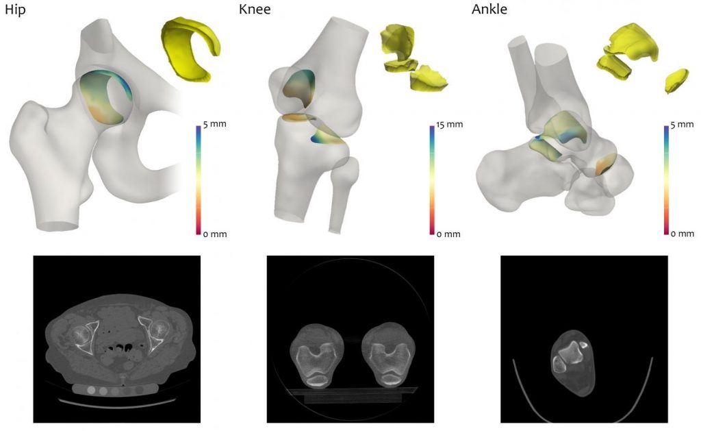 Nueva técnica de medición de lesiones 3D en osteoartritis https://biotechpromed.com