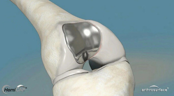 Hemicap W Implante anatómico de superficie trocleo-patelar, de mínima resección (4mm), inlay y no cementado - https://biotechpromed.com/productos-recomendados/hemicap/