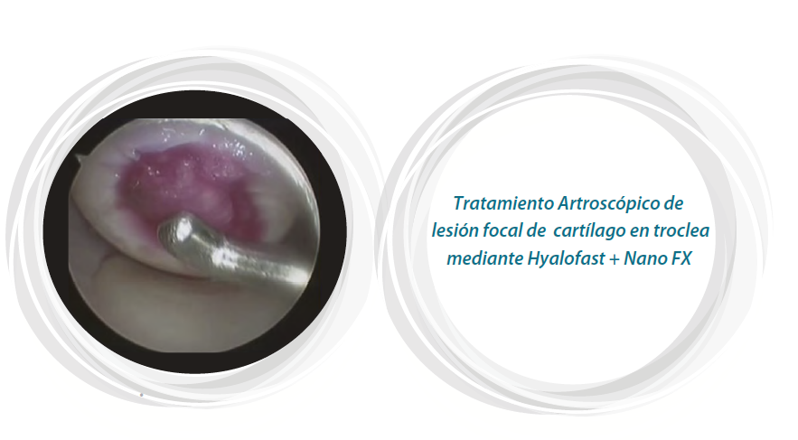 Tratamiento artroscopico de lesion focal cartilago en troclea mediante Hyalofast y Nano Fx https://biotechpromed.com