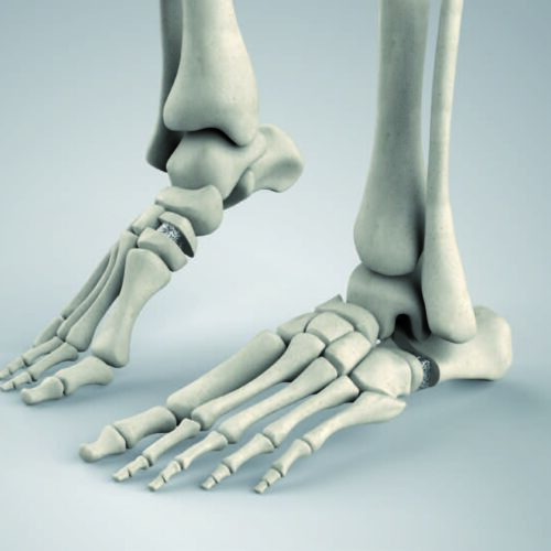 Cuñas porosas OsteoSinter® EVANS y COTTON para el tratamiento de deformidades del pie plano en adultos https://biotechpromed.com
