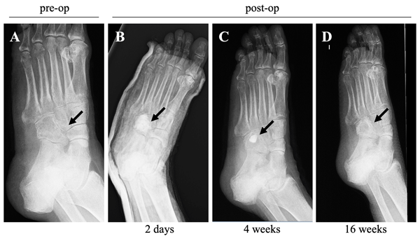 Mycobacterium fortuitum osteomyelitis of the cuboid bone treated with CERAMENT G and V: a case report https://biotechpromed.com