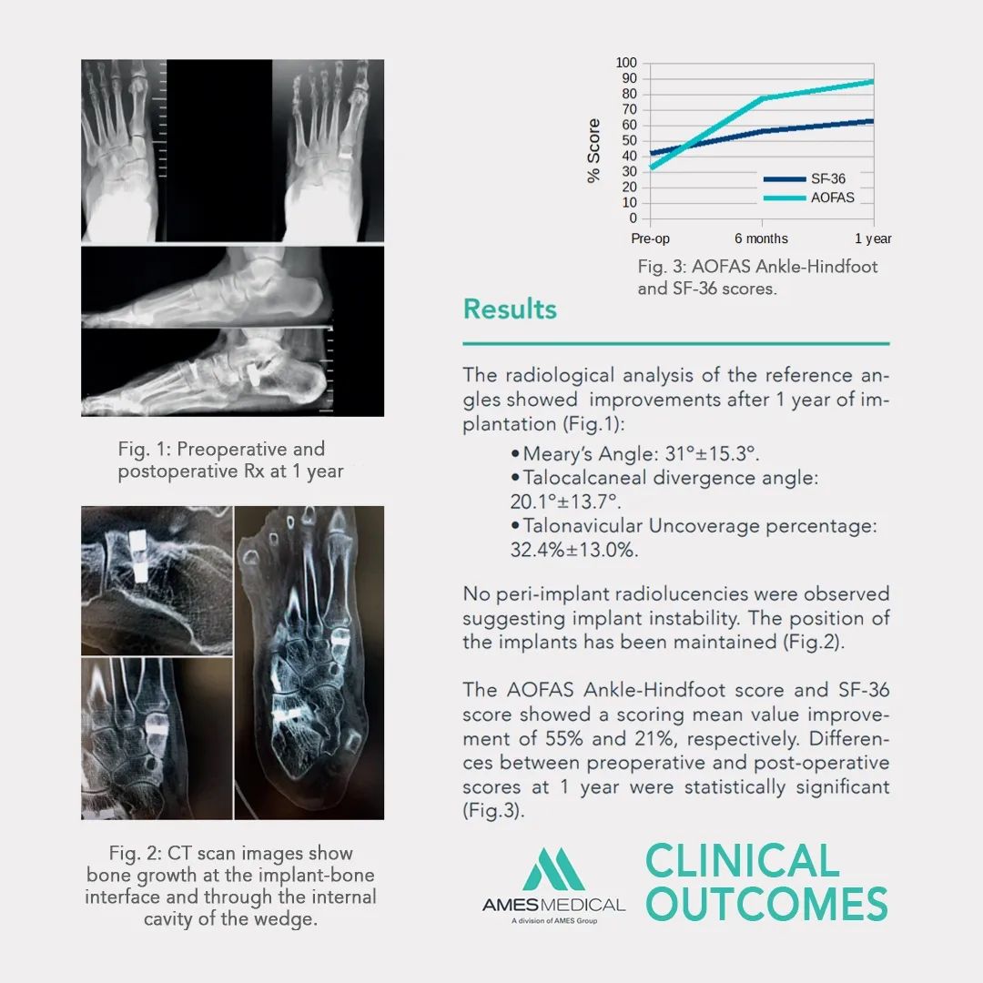 Results Clinical Outcomes EVANS and COTTON Wedges