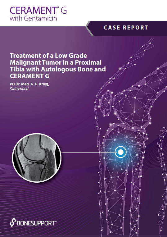 Treatment of a Low Grade Malignant Tumor in a Proximal Tibia with Autologous Bone and CERAMENT G https://biotechpromed.com